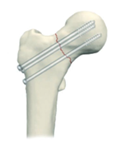 A bone with screws attached to it

AI-generated content may be incorrect.
