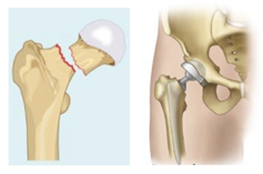 A close-up of a hip bone

AI-generated content may be incorrect.